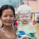 A child from the Sayabouly province effected by albinism, with his grandmother. Lao PDR, Indochina, South East Asia.